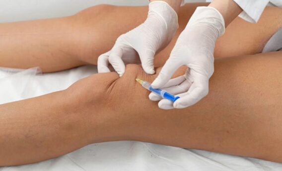 Внутрішньосуглобові ін'єкції гіалуронової кислоти